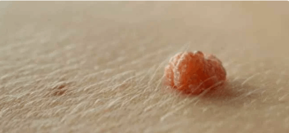 Papilloma virus