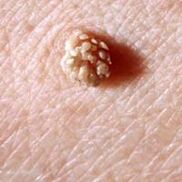 human papillomavirus on skin