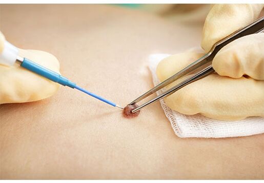 Removing papillomas