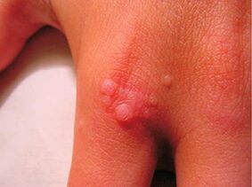 How to get rid of little papillomas
