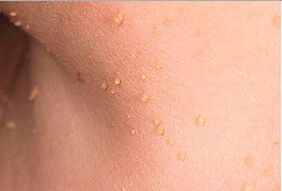 What do papillomas on the body look like