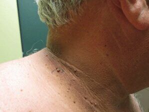 The reasons for the appearance of plural papillomas on the body