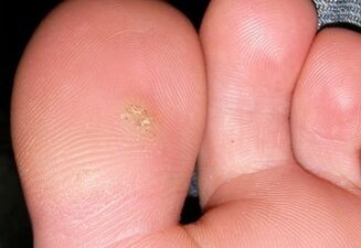 how to get rid of plantar wart