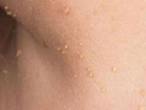 reasons for the appearance of papillomas on the body