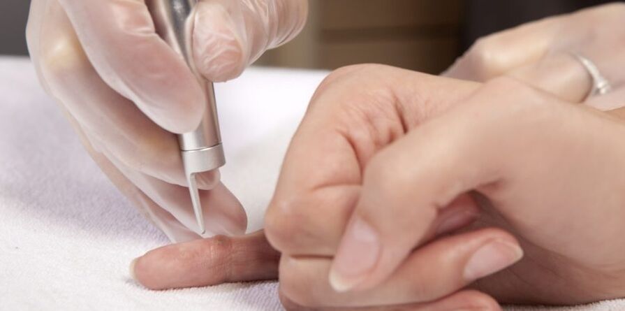 ways to remove papillomas on the hands and why they are dangerous